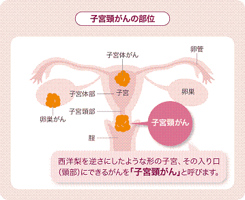 子宮頸がんの部位
